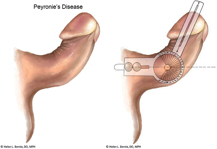 Peyronie's disease 2025 hourglass deformity pictures